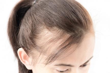 狂掉髮、頭皮癢？小心！有這6大徵兆代表你的頭皮正在加速老化