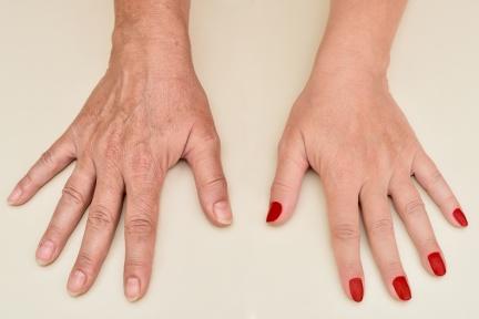 為什麼你的手看起來比實際年齡老？3大「手部顯老」症狀這樣擊退