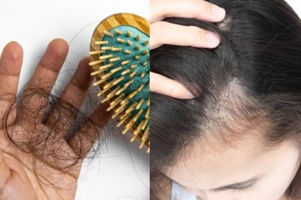 頭皮狂冒痘是怎了？小心難纏的「毛囊炎」失控，會造成永久性掉髮