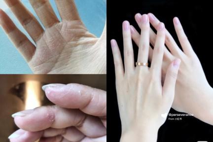 酒精消毒讓手紅腫、乾癢又脫皮！簡單「濕敷療法」4步驟，緩解乾洗手過敏後遺症
