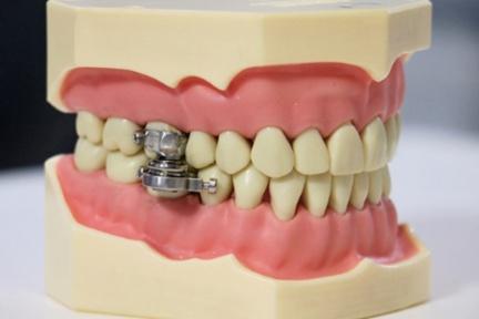 裝「磁鐵牙套」保證瘦超快！嘴巴只能張開0﹒2公分，紐西蘭「最狂減肥神器」你買單嗎？
