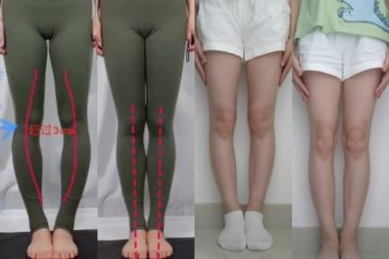 怎麼做才能改善「O型腿」？每天８分鐘！６招矯正＋美化腿形，運動白癡也能上手 
