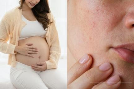 孕媽咪5個常見膚況問題：暗沉肌膚怎麼救？懷孕保養品如何選？落髮真的無法避免？