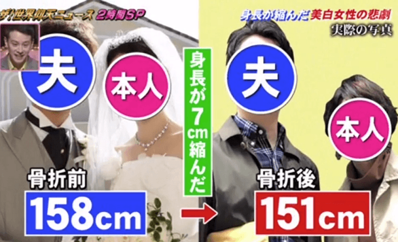 防曬太徹底下場超慘烈！日本26歲女網友一彎腰就骨折，身高還縮水7公分